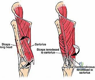 صورة توضيحية لـ ساركوما العضلة الرباعية: دليل شامل لجراحة إنقاذ الطرف والعلاج المتقدم