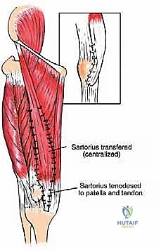 صورة توضيحية لـ ساركوما العضلة الرباعية: دليل شامل لجراحة إنقاذ الطرف والعلاج المتقدم