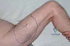 صورة توضيحية لـ ساركوما العضلة الرباعية: دليل شامل لجراحة إنقاذ الطرف والعلاج المتقدم