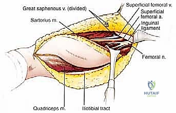 الأعراض السريرية لظهور أورام الفخذ