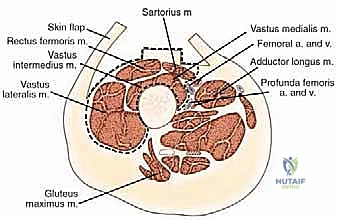 ساركوما العضلة الرباعية: دليل شامل لجراحة إنقاذ الطرف والعلاج المتقدم