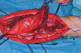 الخزعة النسيجية الدقيقة لتحديد نوع الساركوما