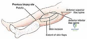صورة توضيحية لـ ساركوما العضلة الرباعية: دليل شامل لجراحة إنقاذ الطرف والعلاج المتقدم