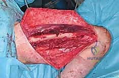 التخطيط الجراحي وتحديد مسار الشق الجراحي