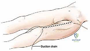 صورة توضيحية لـ ساركوما العضلة الرباعية: دليل شامل لجراحة إنقاذ الطرف والعلاج المتقدم