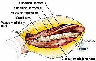 صورة طبية: ساركوما العضلة الرباعية: دليل شامل لجراحة إنقاذ الطرف والعلاج المتقدم