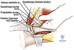 صورة توضيحية لـ ساركوما العضلة الرباعية: دليل شامل لجراحة إنقاذ الطرف والعلاج المتقدم