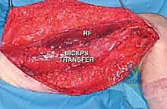 Masterclass: Limb-Sparing Quadriceps Resection for Sarcoma