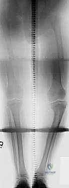 الضغط الميكانيكي وتأثير السمنة كعامل خطر رئيسي في تطور مرض بلونت