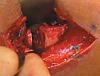 تشريح مفصل الركبة وتأثير مرض بلونت على صفيحة النمو والمحور الميكانيكي