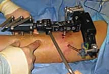 مقارنة بين التثبيت الداخلي والتثبيت الخارجي في جراحات العظام