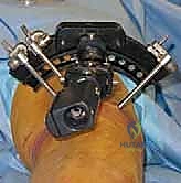 استخدام التصوير المقطعي ثلاثي الأبعاد للتخطيط الجراحي الدقيق لمرض بلونت