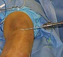 الأعراض السريرية لمرض بلونت: التقوس الشديد واختلاف طول الساقين