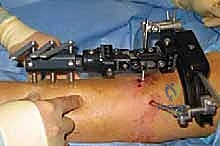 صورة توضيحية لـ مرض بلونت لدى المراهقين: تصحيح تشوه الساق بتقنية قطع العظم والتثبيت الخارجي مع الأستاذ الدكتور محمد هطيف