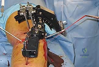 إجراء الشق الجراحي وقطع العظم بدقة متناهية تحت توجيه الأشعة