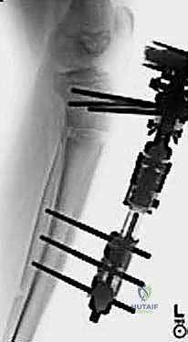 Illustration of adolescent blounts disease - Dr. Mohammed Hutaif