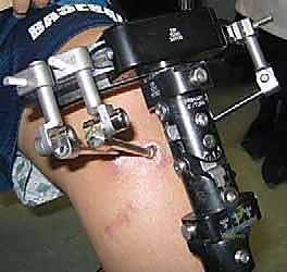 صورة توضيحية لـ مرض بلونت لدى المراهقين: تصحيح تشوه الساق بتقنية قطع العظم والتثبيت الخارجي مع الأستاذ الدكتور محمد هطيف