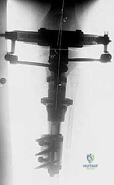 تثبيت الجهاز الخارجي بعد قطع العظم وإغلاق الجرح الجراحي