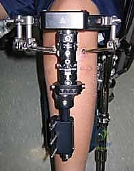 صورة توضيحية لـ مرض بلونت لدى المراهقين: تصحيح تشوه الساق بتقنية قطع العظم والتثبيت الخارجي مع الأستاذ الدكتور محمد هطيف