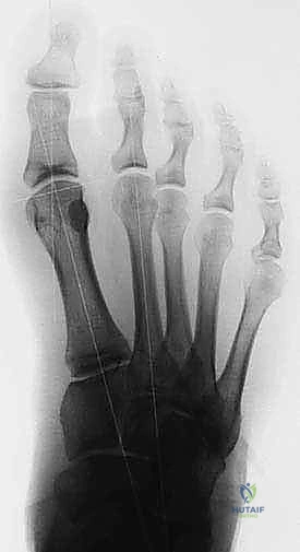 FIG 10  Preoperative  A  and postoperative  B  standing radiographs of the foot showing no change in the clinical alignment of the metatarsophalangeal joint after tibial sesamoidectomy