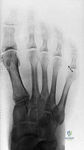 FIG 10  Preoperative  A  and postoperative  B  standing radiographs of the foot showing no change in the clinical alignment of the metatarsophalangeal joint after tibial sesamoidectomy