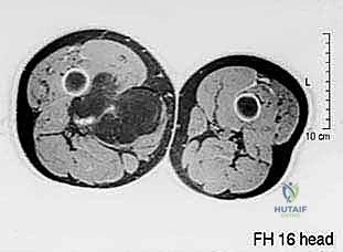 تشريح عضلات الفخذ والأورام العميقة