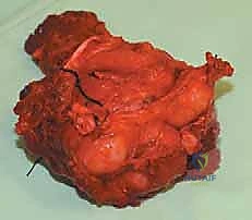 أعراض وعلامات أورام الفخذ