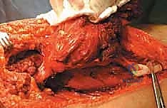 خطوات الجراحة الميكروسكوبية لاستئصال الورم