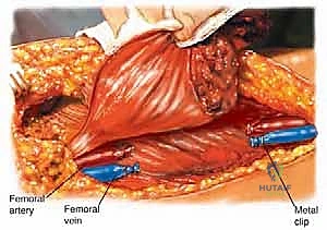 استئصال ورم الفخذ الحافظ للأطراف: دليل شامل لمرضى ساركوما الفخذ مع الأستاذ الدكتور محمد هطيف