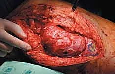 التشخيص الدقيق لسرطان الفخذ