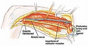 التحضير لعملية استئصال ورم الفخذ