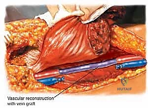 نجاح جراحات أورام العظام في اليمن