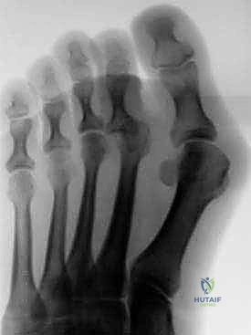 عملية نقل الوتر لعلاج إصبع المطرقة المرن: دليل شامل للمرضى مع الأستاذ الدكتور محمد هطيف