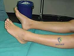 صورة توضيحية لـ عملية نقل الوتر لعلاج إصبع المطرقة المرن: دليل شامل للمرضى مع الأستاذ الدكتور محمد هطيف