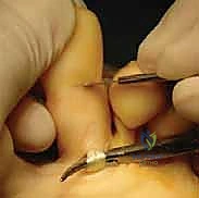 الفحص السريري لتشوه إصبع المطرقة المرن