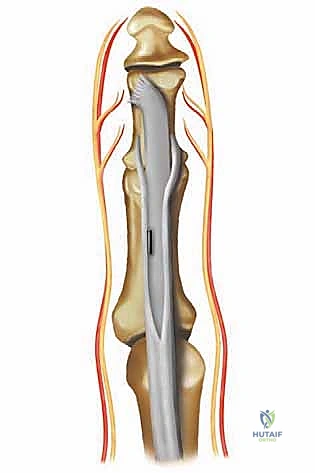 صورة توضيحية لـ عملية نقل الوتر لعلاج إصبع المطرقة المرن: دليل شامل للمرضى مع الأستاذ الدكتور محمد هطيف