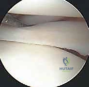 Knee Arthroscopy Masterclass: Comprehensive Intraoperative Techniques & Anatomy