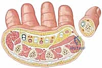 صورة توضيحية لـ كسور عظام اليد المشطية