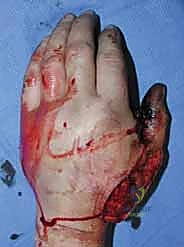 كسور عظام اليد المشطية: دليل شامل للعلاج الجراحي مع الأستاذ الدكتور محمد هطيف