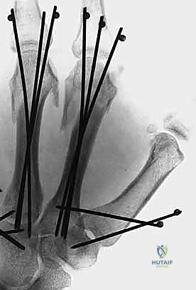 تثبيت بأسلاك K-wires