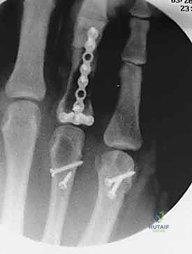 صورة شعاعية توضح التراكب