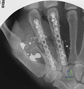 أنواع كسور المشطيات