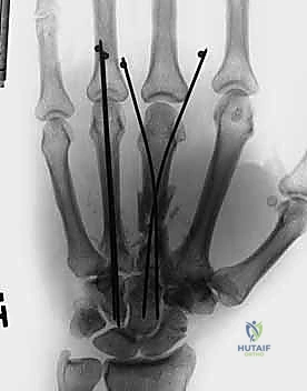 صورة شعاعية للأسلاك