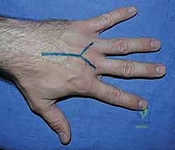 تأثير الإصابة المباشرة على العظم