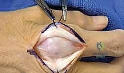 صورة توضيحية لـ كسور عظام اليد المشطية: دليل شامل للعلاج الجراحي مع الأستاذ الدكتور محمد هطيف