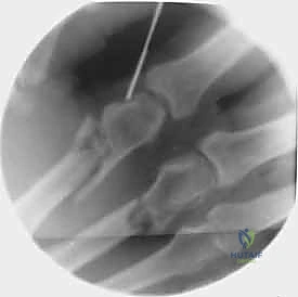 تثبيت نخاعي 1