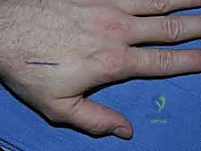 صورة توضيحية لـ كسور عظام اليد المشطية: دليل شامل للعلاج الجراحي مع الأستاذ الدكتور محمد هطيف