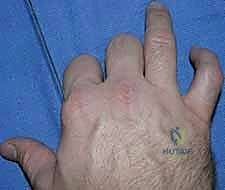 خطوة جراحية 7