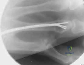 خطوة جراحية 2