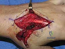 تثبيت نخاعي 4